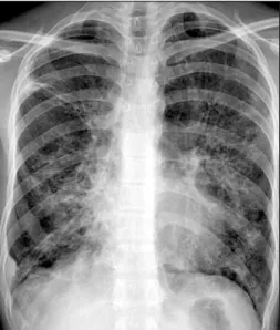 Figure  2.  Chest  computed  tomography  shows  multifocal  bronchiectasis  with  secondary  infection  in  both  lungs.