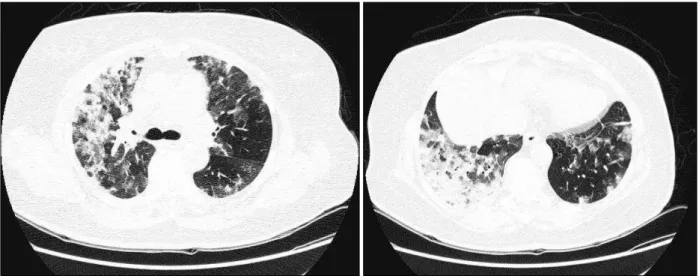 Figure  2.  HRCT  scan.  Initial  HRCT  scan  shows  diffuse,  the  mixed  area  of  consolidation  and  ground-glass  attenuation.