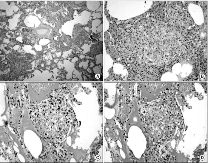 Figure  3.  Open  lung  biopsy.  (A)  Lymphocyte  infiltration  and  small  non-caseating  granulomas  are  predominantly  found in the peribronchiolar interstitium (H&amp;E stain, ×100)