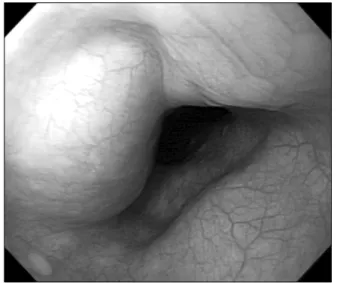 Figure  3.  Endoscopic  finding  of  esophageal  submucosal tumor.  There was a 1.7  cm-sized elevated lesion,  which  was  covered  with  normal  esophageal  mucosa  and  showed  positive  rolling-sign,  at  28  cm  from  incisor.