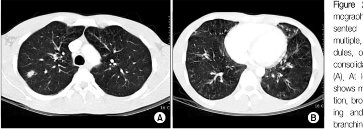 Figure  2.  Computed  to- to-mography  from  the   pre-sented  patient,  there  are  multiple,  variable-sized,   no-dules,  or  nodular  airspace  consolidation  in  both  lungs (A)