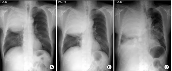 Figure  1.  (A)  Chest  radiography  at  admission  showed  a  huge  mass  with  buldge  out  of  the  major  fissure  in  the  right upper  lobe