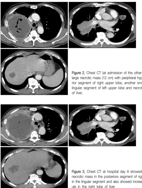 Figure  2.  Chest  CT  (at  admission  of  the  other  hospital)  showed  a  huge large necrotic mass (12 cm) with peripheral hypervascularity in the  poste-rior  segment  of  right  upper  lobe,  another  small  necrotic  nodule  in  the  lingular  segmen