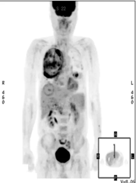 Figure  4.  PET  scan  showed  a  huge  necrotic  mass  with  peripheral  intense  FDG  uptake  in  the  right  lung  and   an-other smaller mass in the left lung