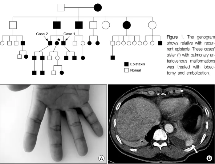 Figure  1.  The  genogram  shows  relative  with   recur-rent epistaxis. These cases' sister (*) with pulmonary  ar-teriovenous  malformations  was  treated  with   lobec-tomy  and  embolization.