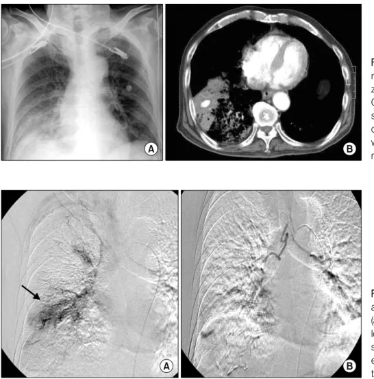 Figure 1. (A) Initial chest X- X-ray at admission shows  ha-ziness in right lower lung