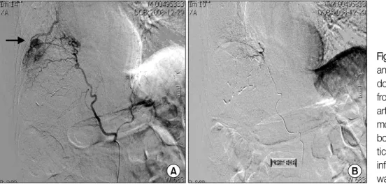 Figure  4.  Disappeared  pseudoaneurysm  of  right  lower  lobe  in  chest  CT  scan  at  10  days  after  embolization.
