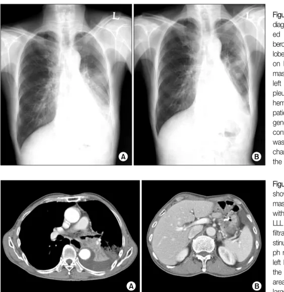 Figure  1.  (A)  At  the  day  of diagnosis, chest X-ray  show-ed  inactive  pulmonary   tu-berculosis on the right upper lobe (RUL) and emphysema on  both  lung,  a  malignant  mass with atelectasis in the  left  lower  lobe  (LLL)  and  pleural  effusion