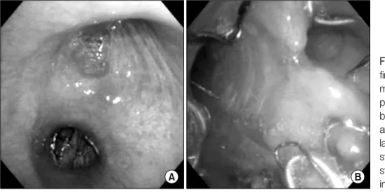 Figure  4.  Bronchoscopic  findings  of  the  inserted  metal stent. Pictures at the proximal  portion  of  the  bronchus  intermedius  (A)  and at the site of the  angu-lation  (B)  showed  that  the  stent  relieved  the   ob-struction  of  right  bronch