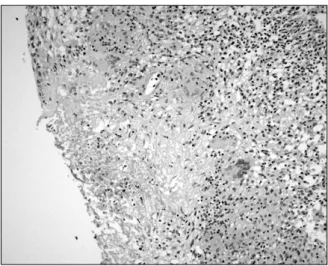 Figure  2.  Microscopic  finding  shows  multiple  scattered  granulomas  with  central  necrosis  (H&amp;E  stain,  x200).