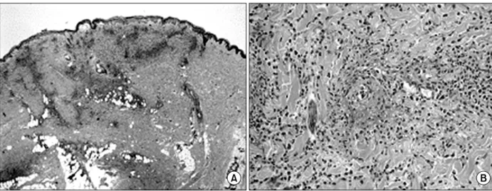 Figure 3. Microscopic findings of skin biopsy. (A) Infiltration of inflammatory cells were seen from the dermis to subcuta- subcuta-neous fat tissue (H&amp;E stain, ×40)