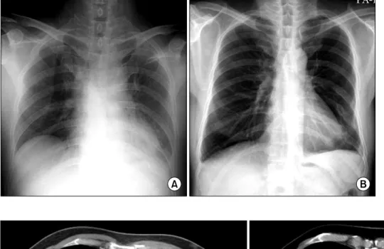 Figure  1.  Chest  radio- radio-graphs  showing  multiple  rib fractures and increased opacity  in  left  lower  lung  (A:  admission),  and  some  rib calluses and cleared left lower  lung  opacity  (B:  1  year  after  discharge).