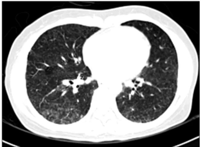 Figure  4.  Chest  CT  scan  shows  bilateral  diffuse  ground  glass opacities and tiny nodular infiltration on both lungs.
