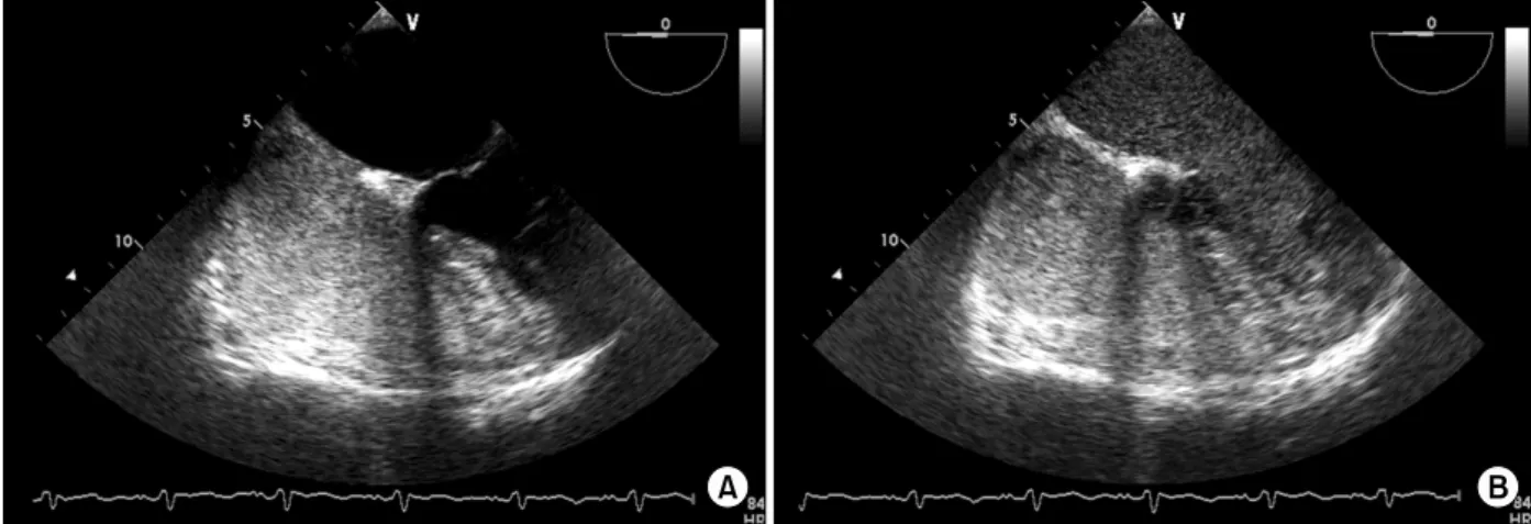 Figure 2. (A) The contrast-enhanced transesophageal echocardiograms with agitated saline showed microbubbles opaci- opaci-fying only the right cardiac chambers