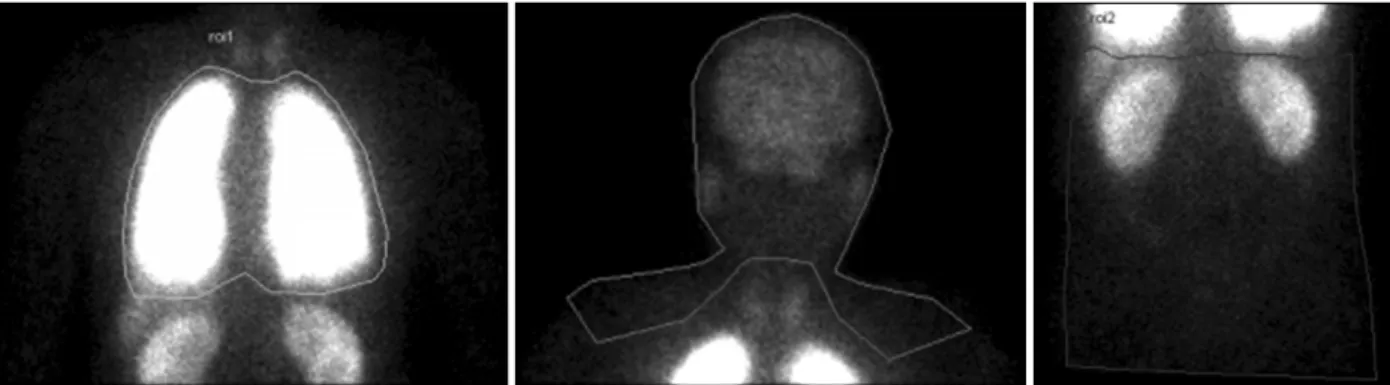 Figure 3. The technetium-99m-labeled magroaggregated albumin perfusion scan revealed abnormal uptakes in the brain, thyroid  gland,  and  kidneys,  indicating  right-to-left  shunt