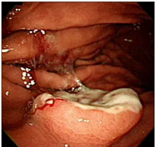 Figure  1.  Initial  gastrofiberscopy  showed  3.2  cm  sized  polypoid  mass  with  ulceration  in  the  body  of  stomach.