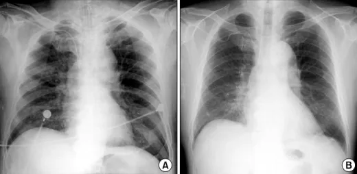 Figure 2. (A) Pre-emboliza- Pre-emboliza-tion,  selective  angiography  of the right bronchial artery shows contrast leakage  in-to  the  right  bronchial   lu-men with parenchymal  pig-mentation