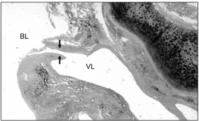Figure 3. Abnormal, dilated vessel is present in the sub- sub-mucosa beneath the cartilage