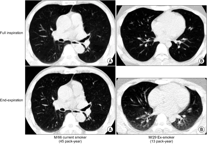 Figure  1.  Examples  of  expiratory  CT  findings.  (A)  Paired  inspiratory  and  expiratory  CT  scan  of  66  years  old  current smoking male with 45 pack-year of smoking amount