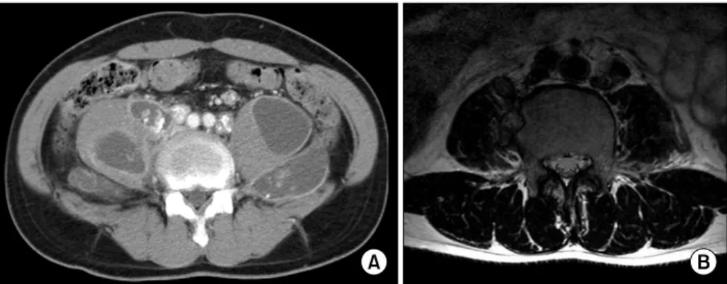 Figure  1.  (A)  Abdomen  dynamic  CT  show  multiple  large  necrotic  regions  in  both  psoas  muscle  and  well  enhancing calcified  enlarged  lymph  nodes  in  both  iliac  chains