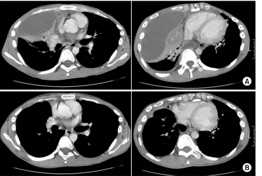 Figure  2.  (A)  Chest  CT: 