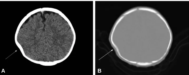 Fig. 2. This Brain computed tomography shows a ping-pong fracture on right parietal bone (Arrow)