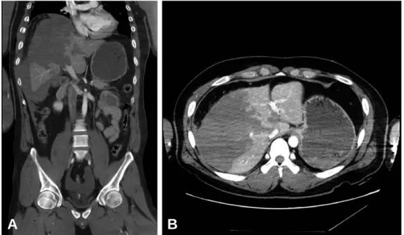 Fig. 1. Abdominal computed tomography finding showed at immediate post injury. (A) Deep laceration of hepatic right lobe is showed in coronal view of computed tomography
