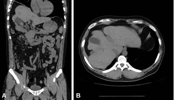 Fig. 3. CT finding at 15 months after injury. (A) Coronal section, right hepatic lobe is slinking after injury, there is no peritoneal biloma