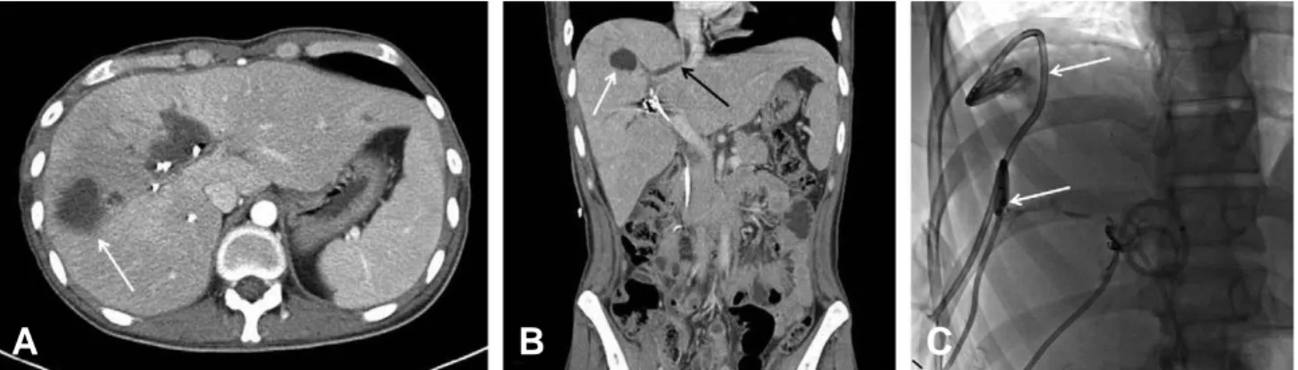Fig. 2. Bile leak and biloma in right liver. (A) Abdominal computed tomography reveals increased biloma in hepatic segment IV, V and VIII
