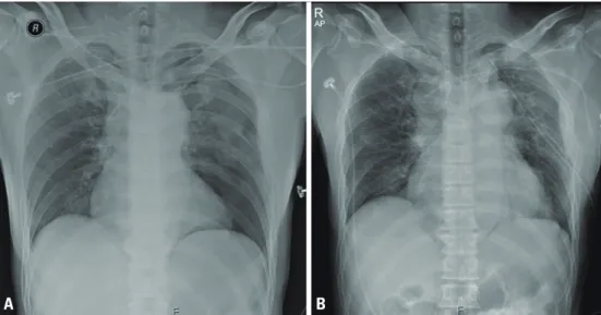 Fig. 1. (A) Left pneumothorax, as seen on the initial chest X-ray. (B) Mediastinal shadow widening was observed on computed tomography.