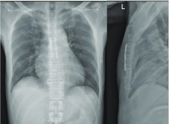 Fig. 3. The fractured sternum was fixed using SternaLock® (Biomet Microfixation Inc., Jacksonville, FL, USA), a steel wire, and figure-of-eight sutures.
