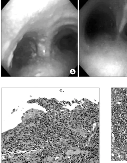 Figure 2. (A) Fiberoptic  bronchoscopy shows  mul-tiple nodular mucosal  le-sions in the trachea and  bronchi