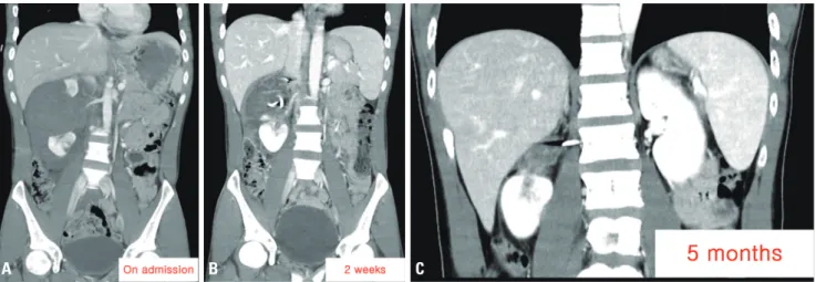 Fig. 4. (A-C) These computed tomography images show the postprocedural course of the patient with a grade V injury