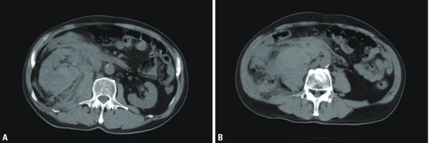 Fig. 5. (A) Abdominal non-contrast computed tomography (axial image) in the patient with a grade IV injury shows large right perirenal and pararenal  hematomas