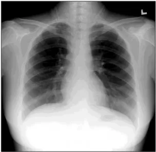 Figure 1. PA view shows no parenchymal abnormality in  both  lungs.  PA:  pulmonary  artery.