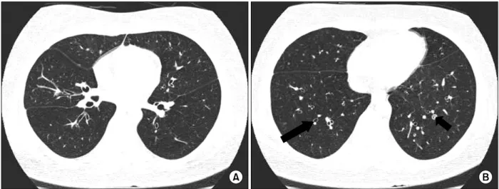 Figure  2.  Chest  HRCT  image  at  the  level  of  inferior  pulmonary  vein  shows  subtle  hyperlucency  of  right  middle  and  both  lower  lobes,  which  was  more  evident  on  images  taken  during  expiration  (not  shown)  (A)  and  bronchial  di