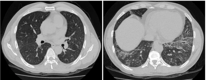Figure  1.  Chest  PA  shows  diffuse  bilateral  haziness  in  both  lower  lobes  with  decreased  lung  volume.