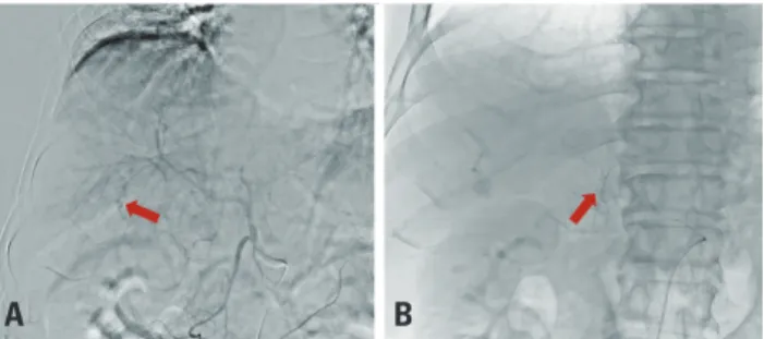 Fig. 4. (A) Percutaneous gallbladder drainage (PTGBD) insertion on the  third day after angioembolization