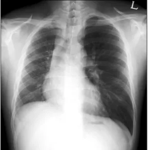 Figure  1.  Chest  radiograph  shows  an  enlarged  left  lung  and small, hypoplastic right lung with increased interstitial markings  in  right  lung  zone.