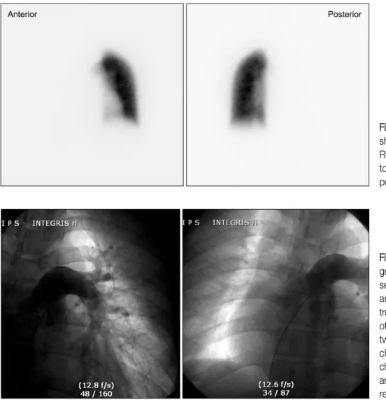 Figure 3. A perfusion scan  shows  perfusion  defect  in  Rt.  lung,  consistent  with  total obstruction  of the  Rt