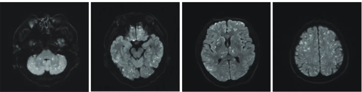 Fig. 2. Initial magnetic resonance diffusion-weighted images 3 hours after trauma display no abnormal findings.