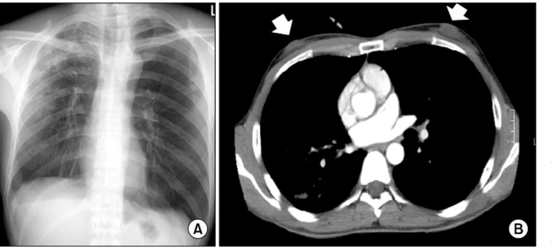 Figure 1. Chest PA and en- en-hanced Chest CT scan. (A)  Multiple  ill  defined  patchy  and nodular densities in the  BULF