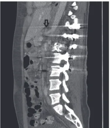Fig. 5. Unkinking of the celiac artery (arrow). Fig. 6. Chest X-ray taken 20 days after admission, showing the collar  sign (arrow).