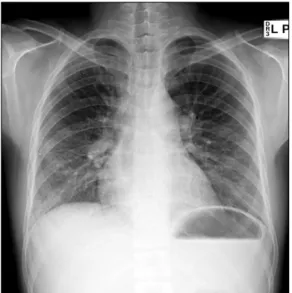 Figure  1.  Chest  PA  shows  diffuse  reticularities  with peri- peri-bronchial  infiltration  on  both  lower  lung  fields.