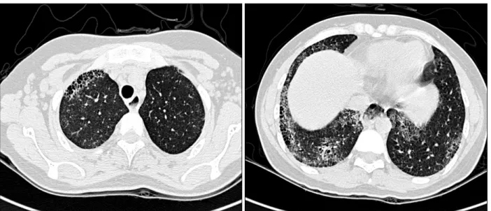 Figure 2. HRCT scan shows interlobular septal thickening, ground glass opacity and  honeycomb appearance on right upper  lung  and  both  lower  lungs.