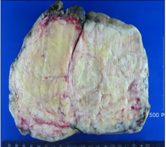 Figure 2. Gross appearance of the tumor. The cut section shows  a  well  circumscribed  encapsulate  white  mass,  measuring  18×13×5  cm.