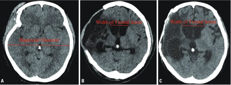 Fig. 1. (A) Computed tomography (CT) images showing progressive ventriculomegaly. The maximal biparietal diameter was checked on the initial CT  images