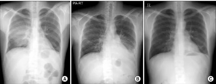 Figure 1. (A) Chest X-ray taken before admission showed pneumonic consolidation on right middle lobe