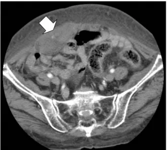 Figure 3. Abdominal computed tomography performed 2 weeks  later  shows  rectus  sheath  hematoma  decreased in  size  (5.2×2.8  cm)