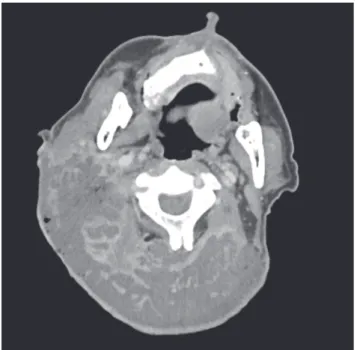 Fig. 1. Neck computed tomography showing a diffused abscess cavity  and gas in the posterior neck, with the muscle intact.